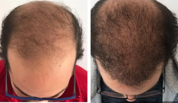 FUE Sapphire — CARTHAGO MED