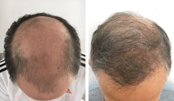 FUE Sapphire — CARTHAGO MED