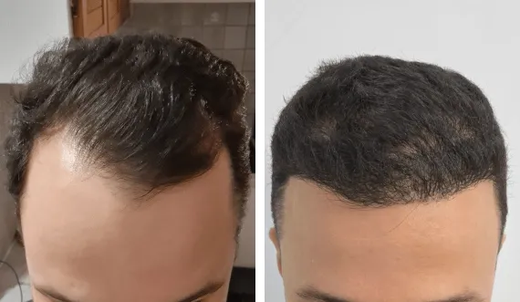 FUE Sapphire — CARTHAGO MED