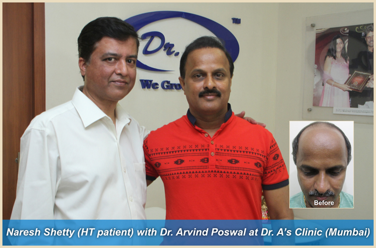 BHT Body Hair Transplant — Dr A's clinic - hair Transplant clinic