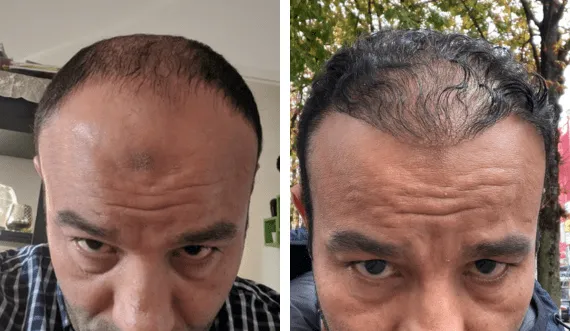 FUE Sapphire — CARTHAGO MED
