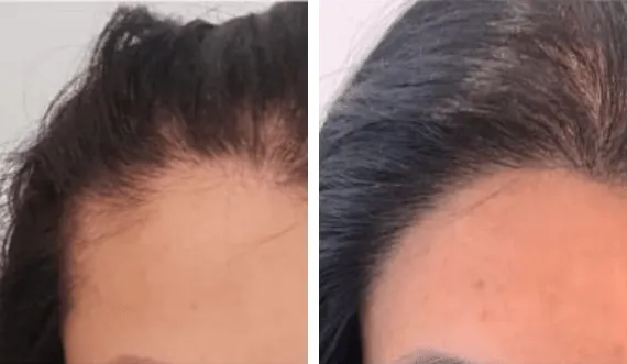 FUE Sapphire — CARTHAGO MED