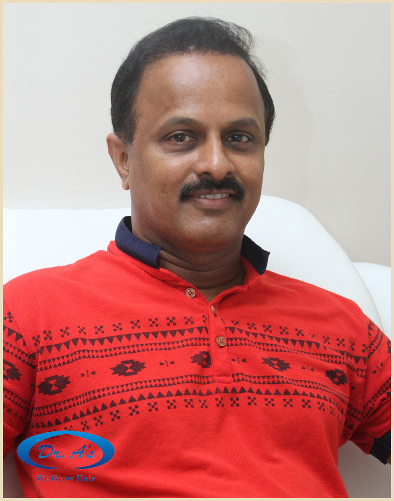 BHT Body Hair Transplant — Dr A's clinic - hair Transplant clinic