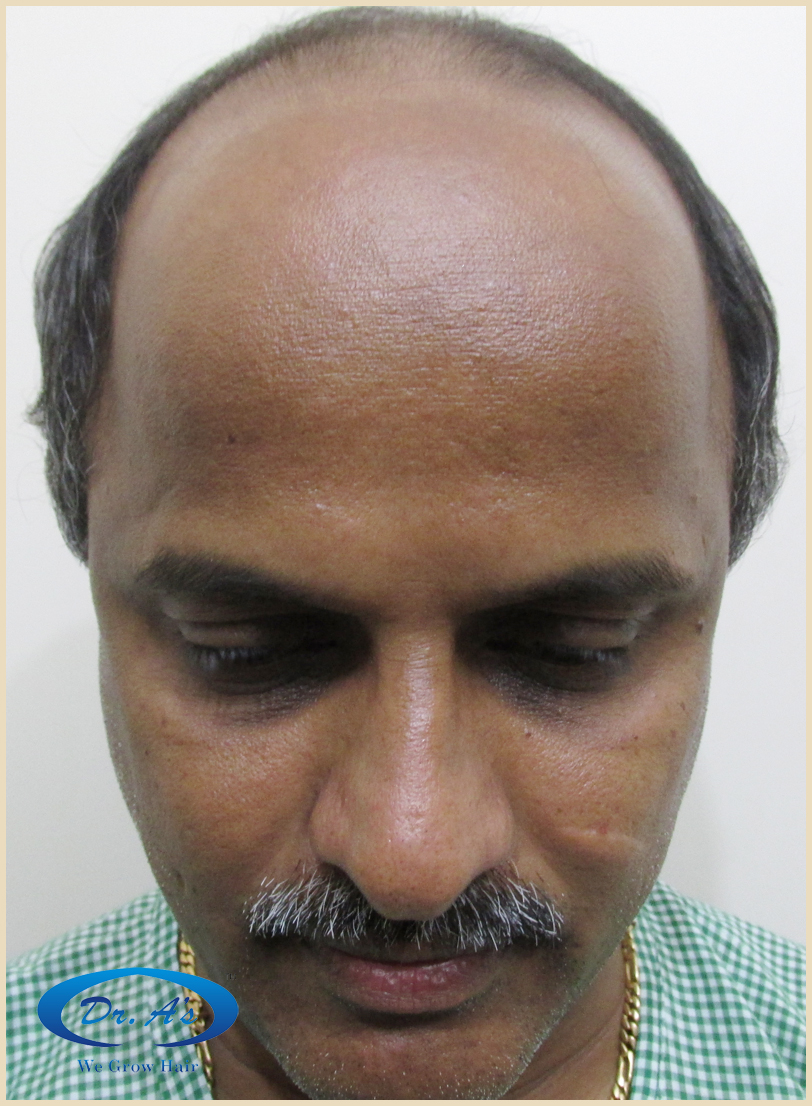 BHT Body Hair Transplant — Dr A's clinic - hair Transplant clinic