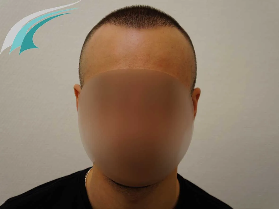 FUE by Doctor — Dr Beyhan Zeybek Hair restoration expert