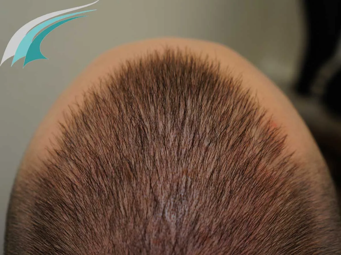 FUE by Doctor — Dr Beyhan Zeybek Hair restoration expert
