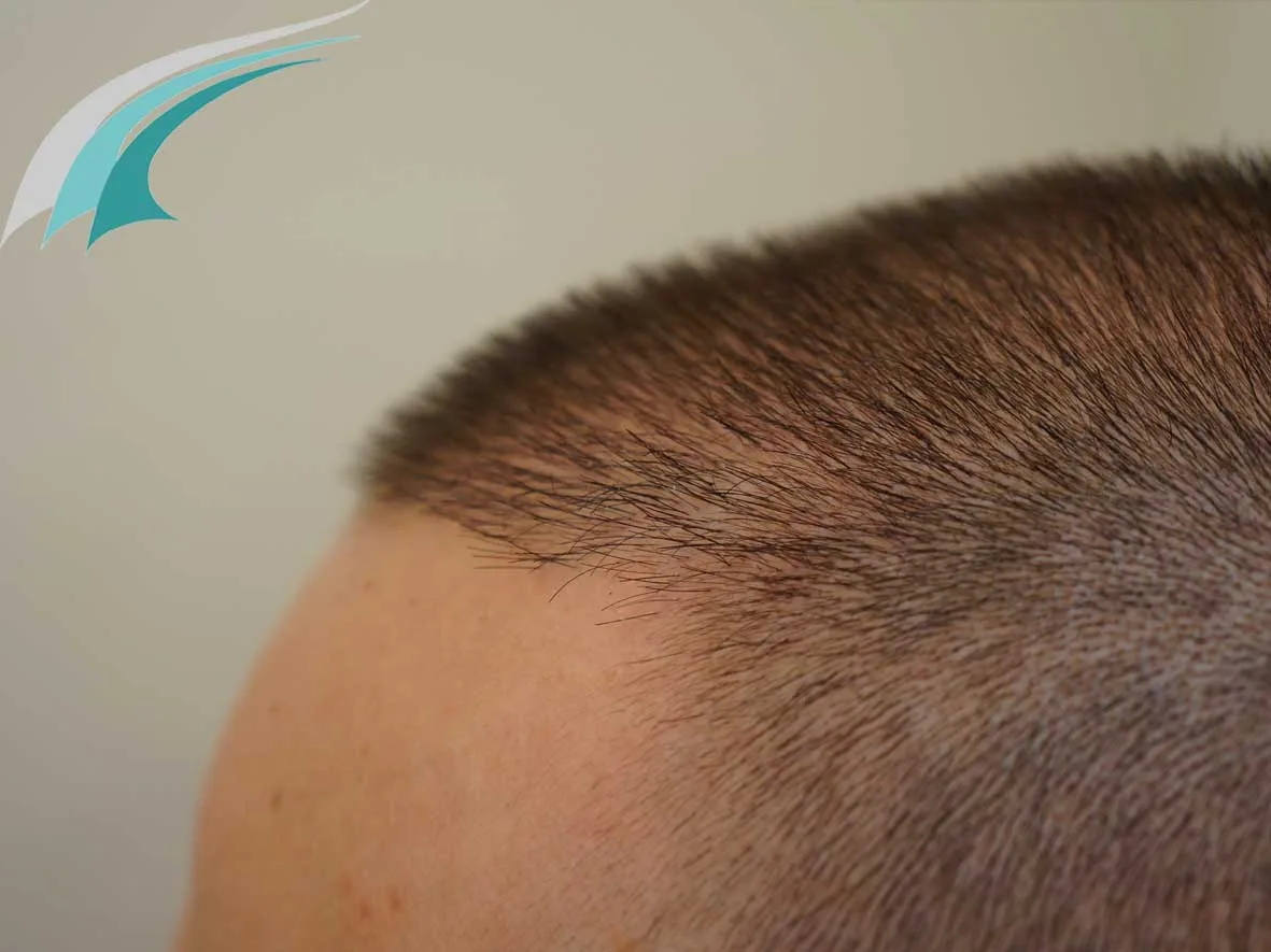 FUE by Doctor — Dr Beyhan Zeybek Hair restoration expert