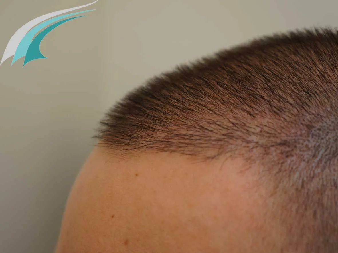 FUE by Doctor — Dr Beyhan Zeybek Hair restoration expert