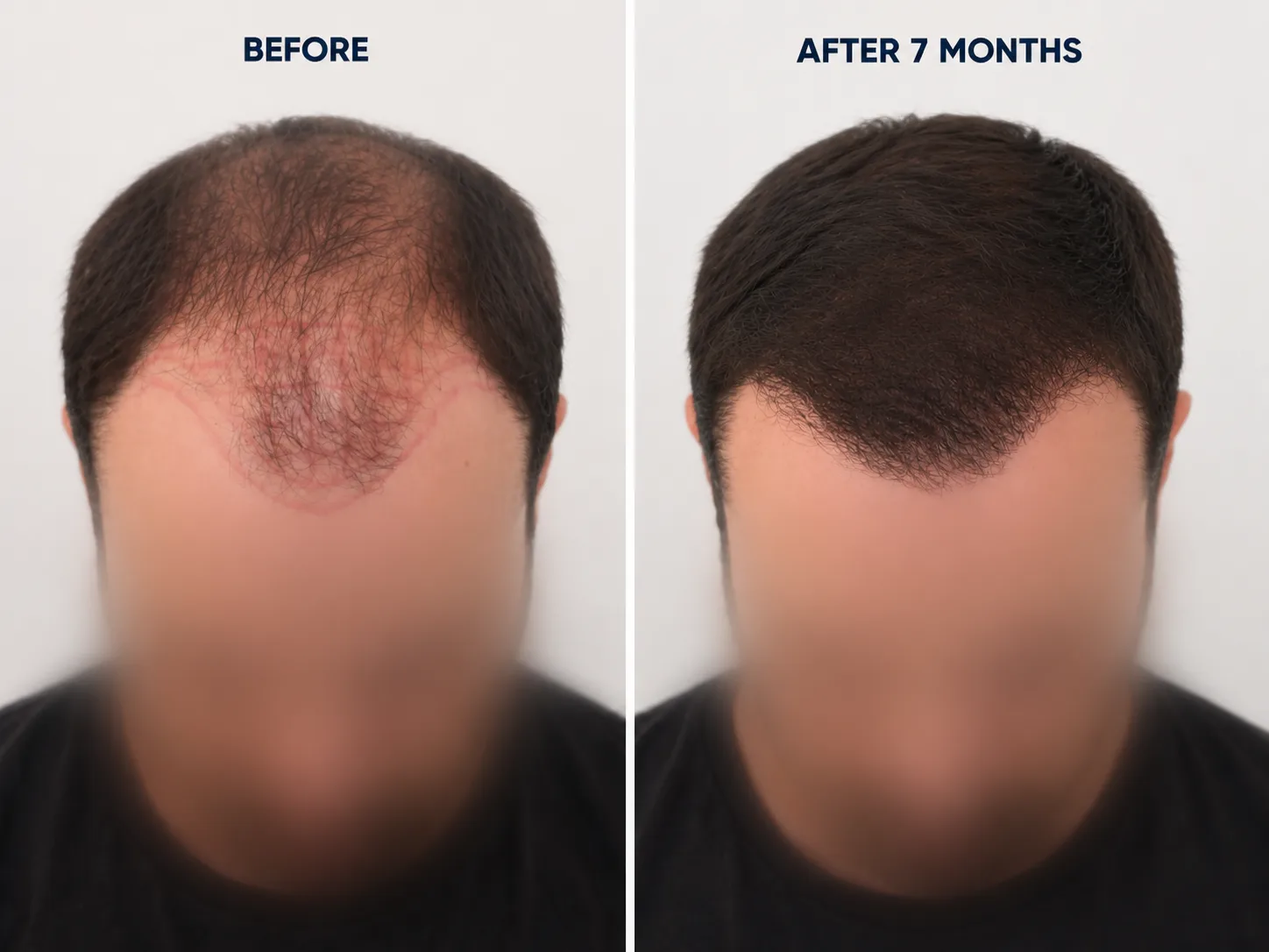 FUE by Doctor — Dr Beyhan Zeybek Hair restoration expert