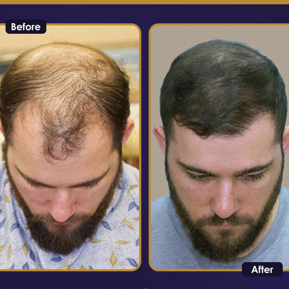 FUE — Estherian clinic