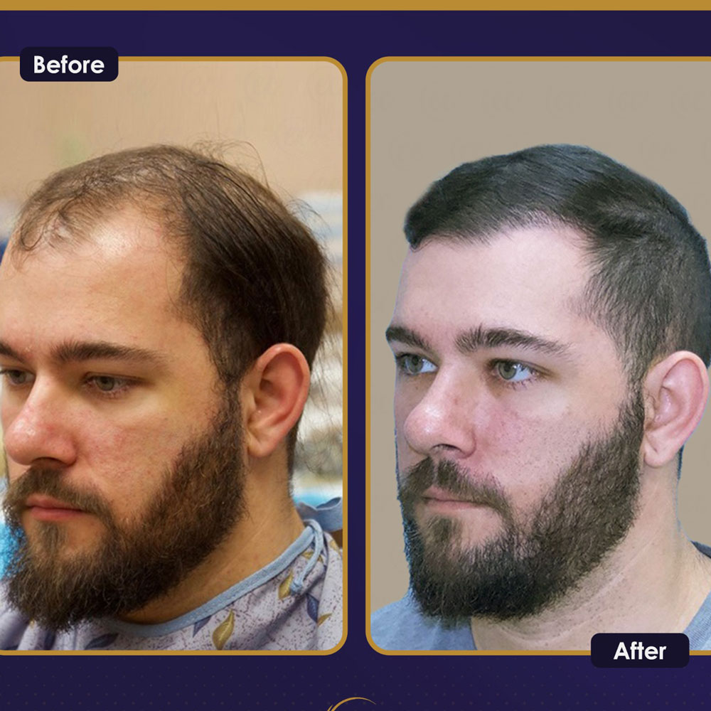 FUE — Estherian clinic
