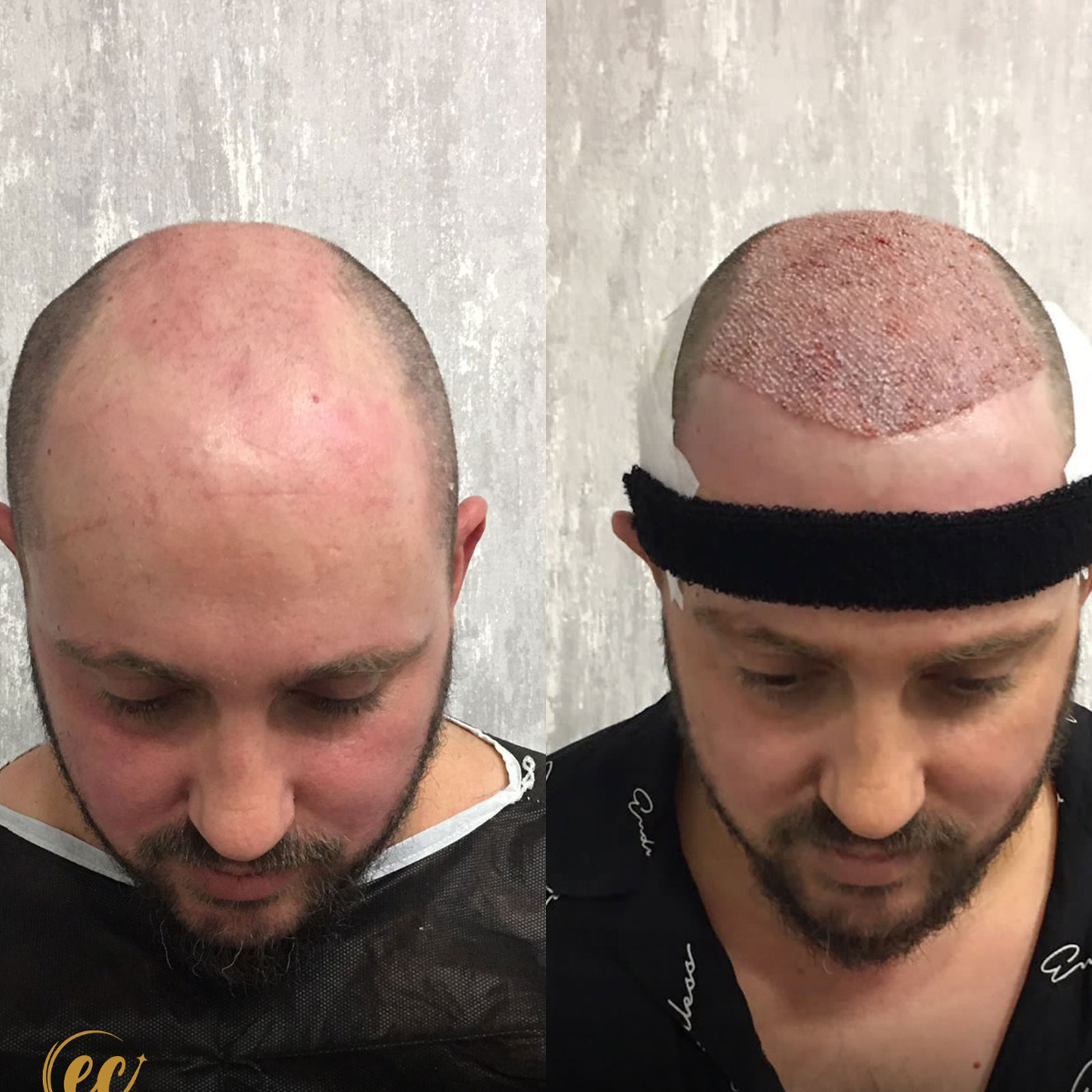 FUE — Estherian clinic