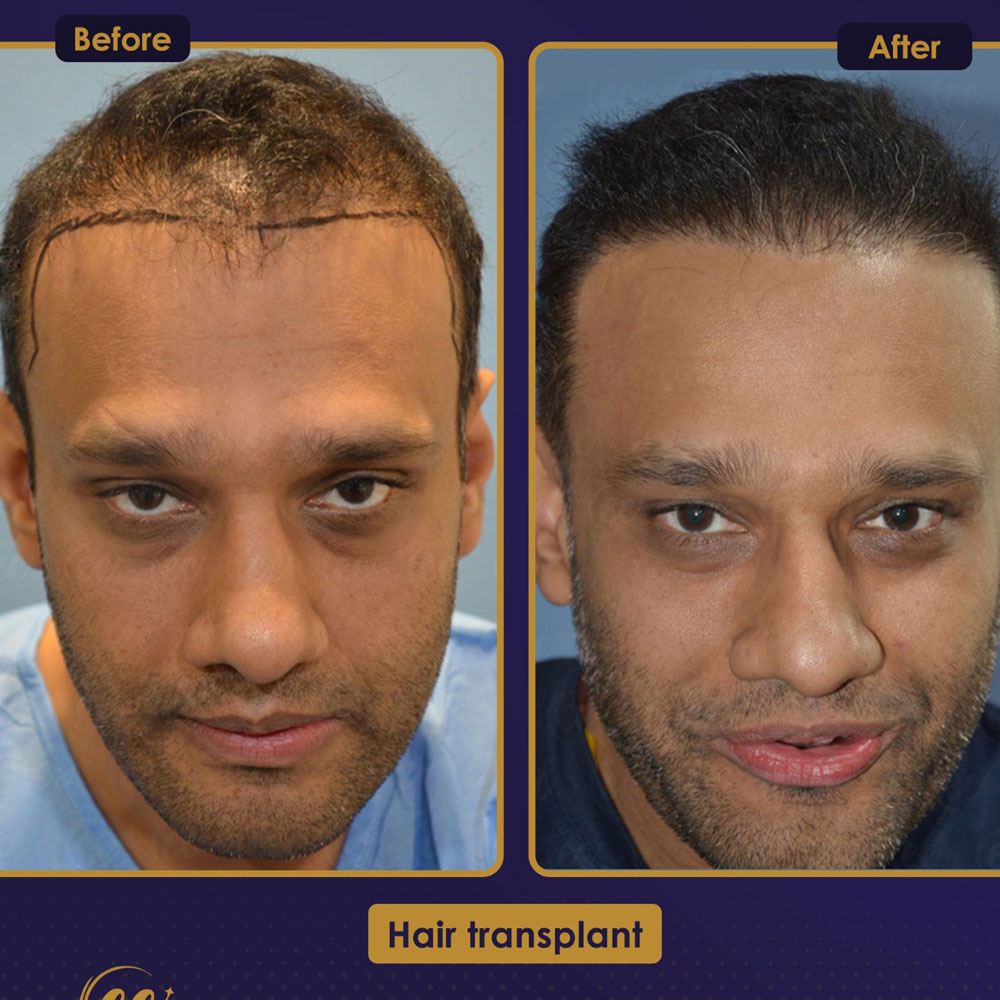 FUE — Estherian clinic