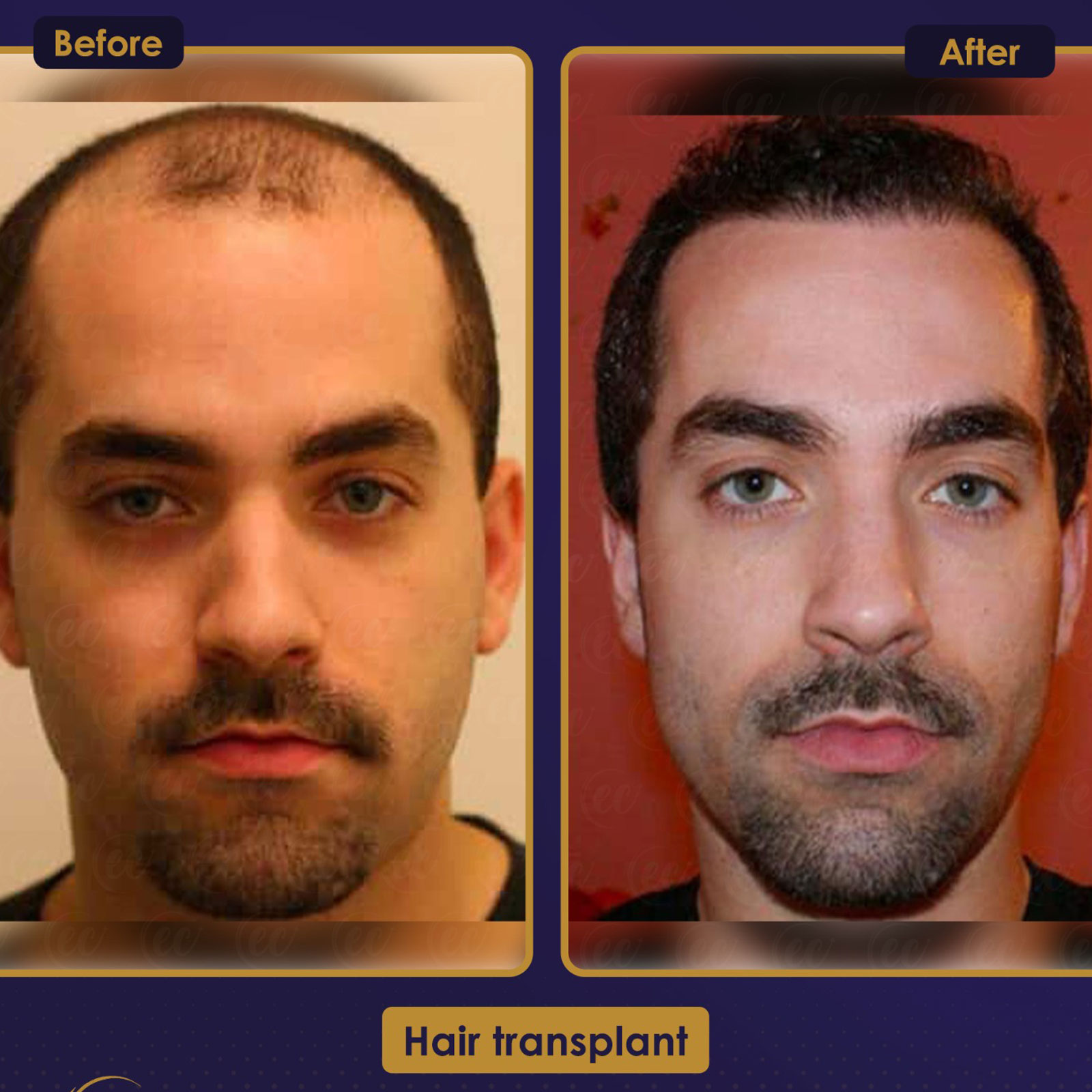 FUE — Estherian clinic