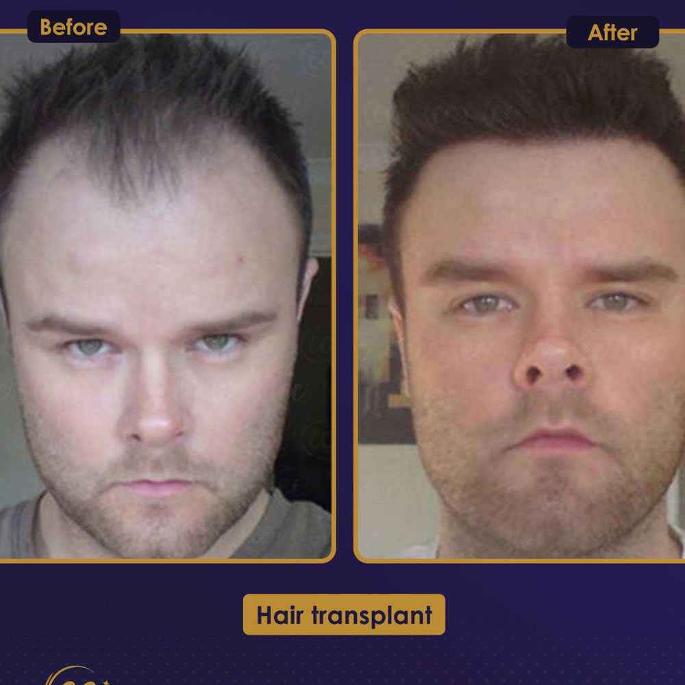 FUE — Estherian clinic