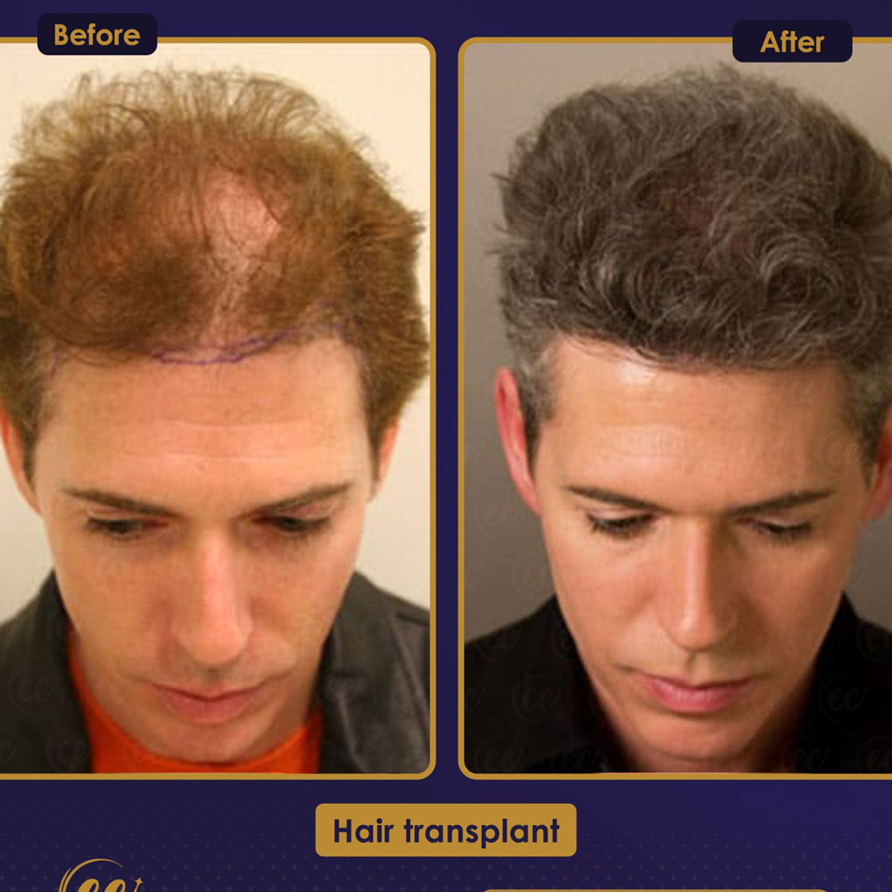 FUE — Estherian clinic