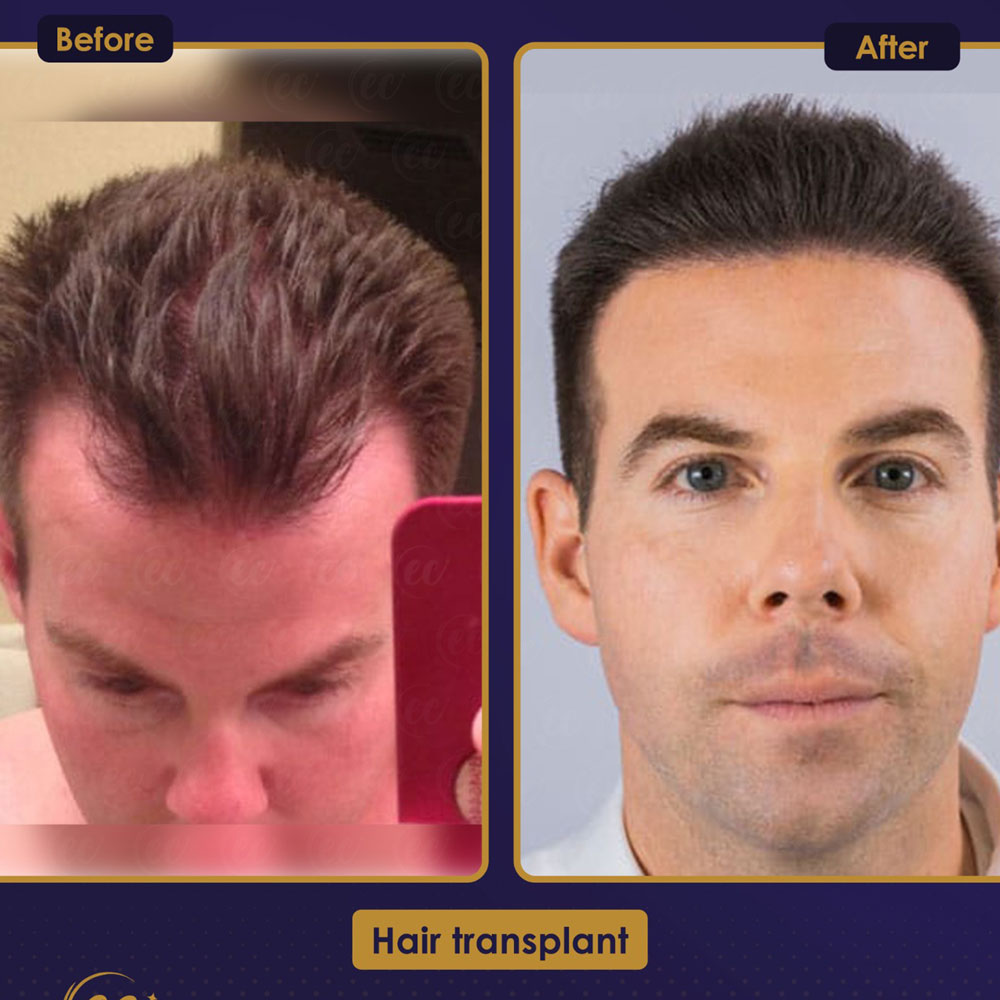 FUE — Estherian clinic