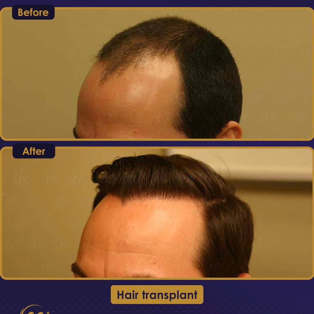 FUE — Estherian clinic