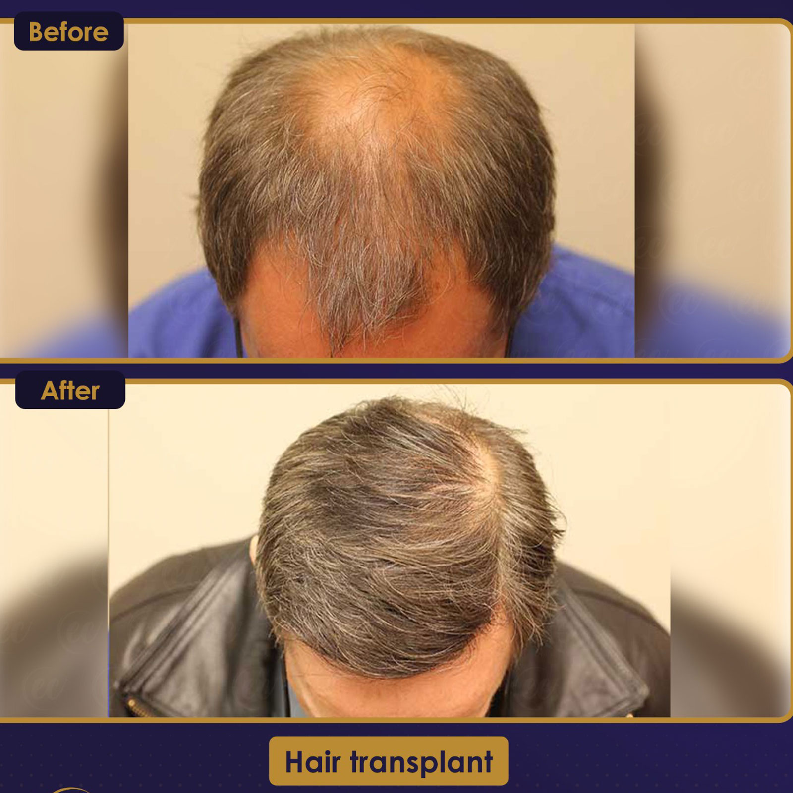 FUE — Estherian clinic