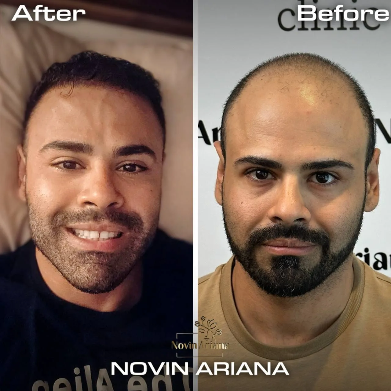 FUE — Novin Ariana BHT Hospital