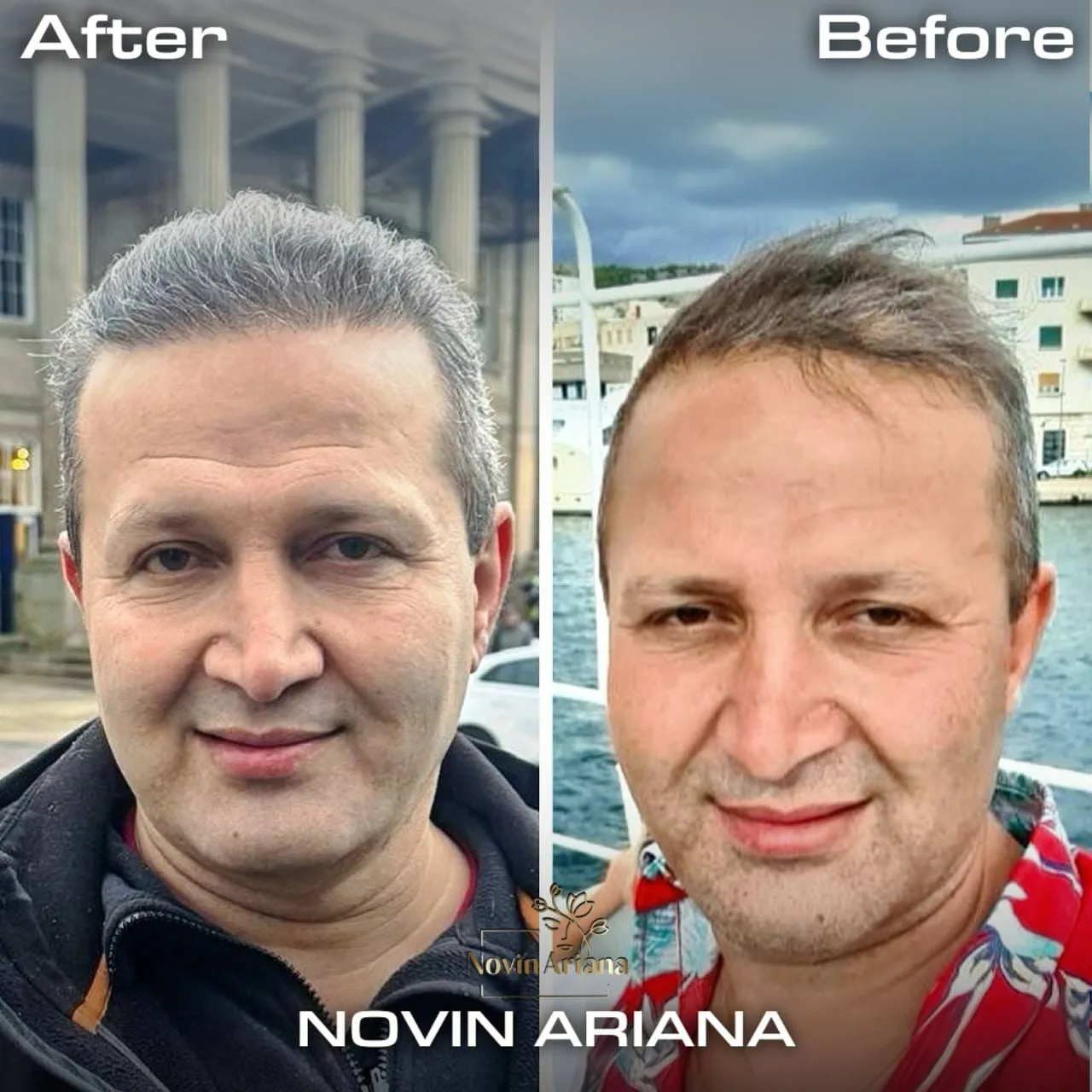 FUE — Novin Ariana BHT Hospital