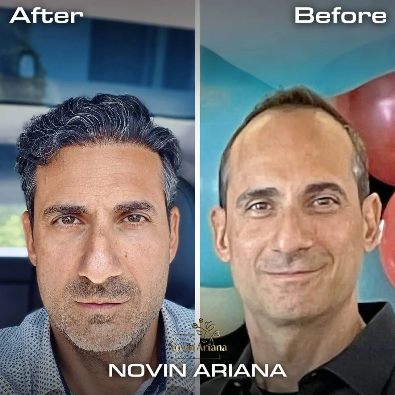 FUE — Novin Ariana BHT Hospital