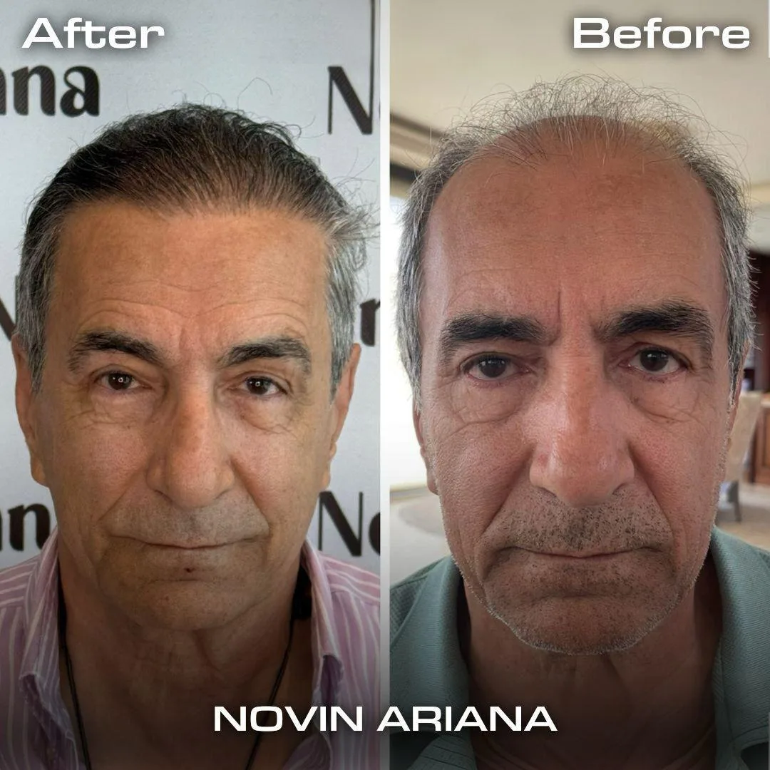 FUE — Novin Ariana BHT Hospital