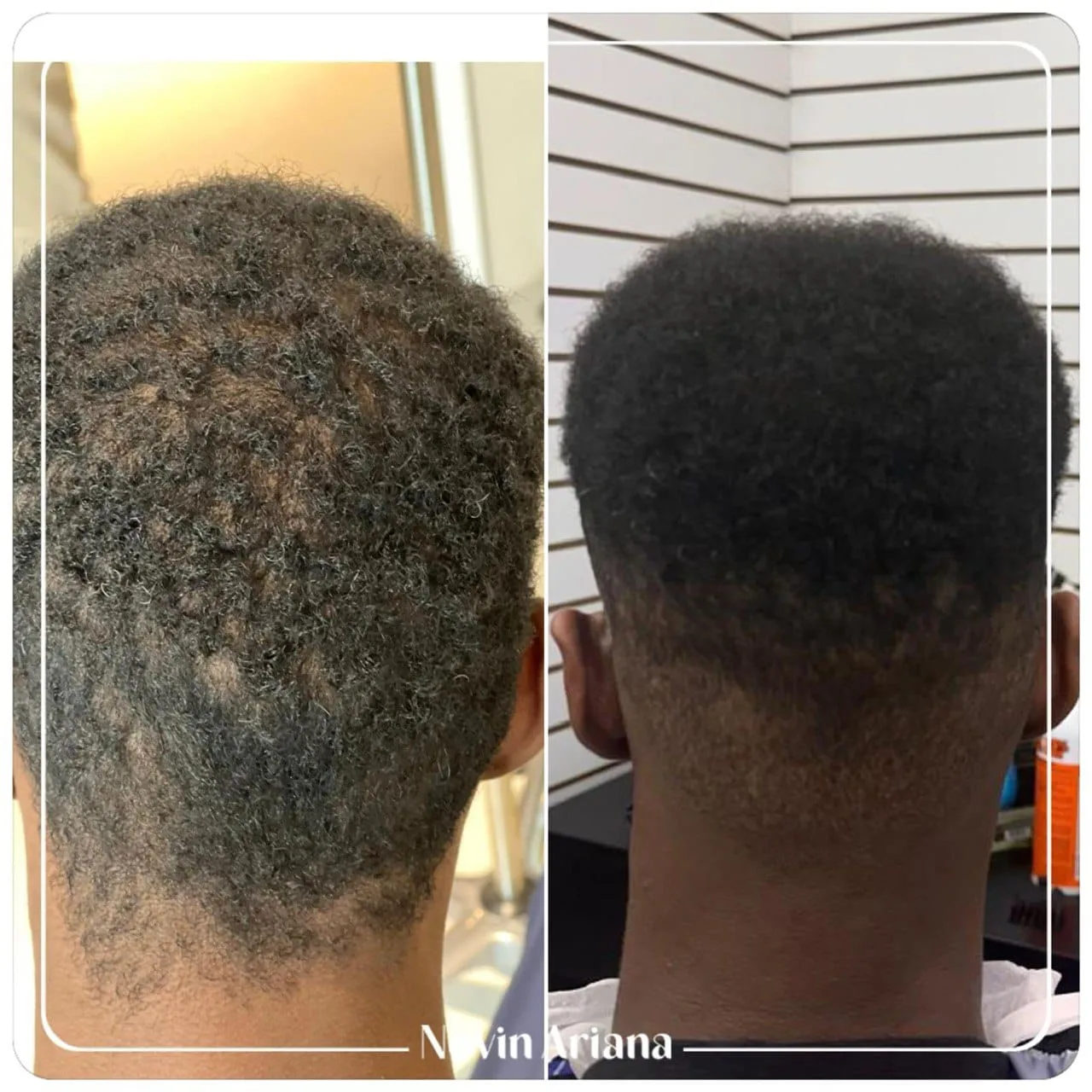 FUE Sapphire — Novin Ariana BHT Hospital