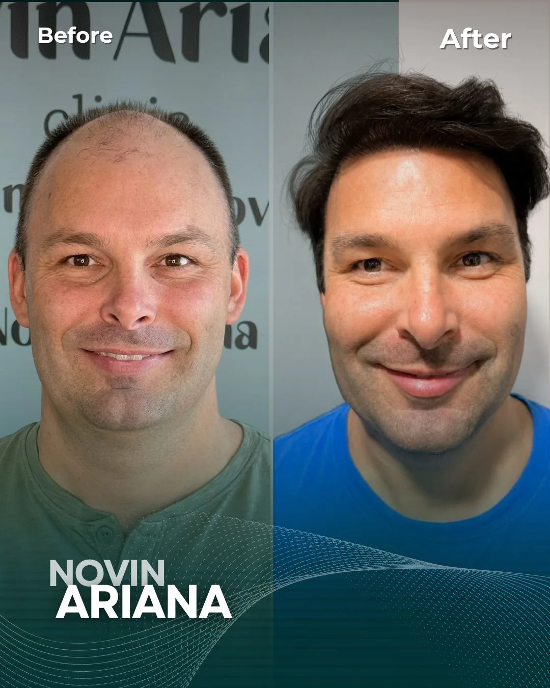 FUE Sapphire — Novin Ariana BHT Hospital