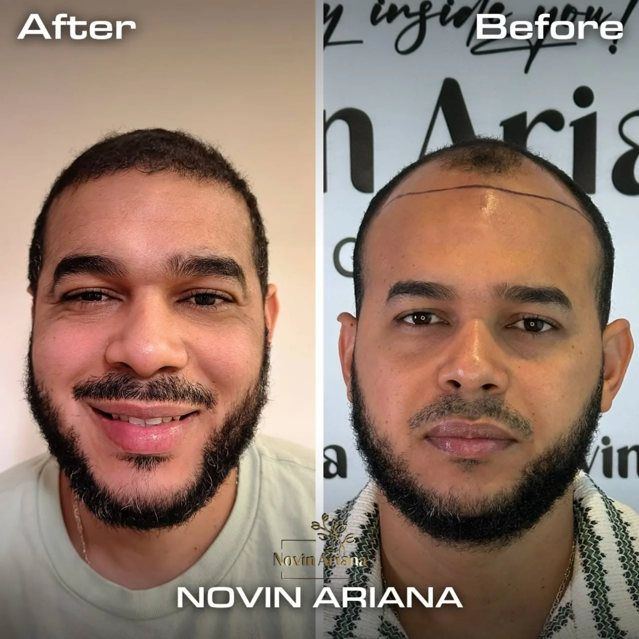 FUE Sapphire — Novin Ariana BHT Hospital