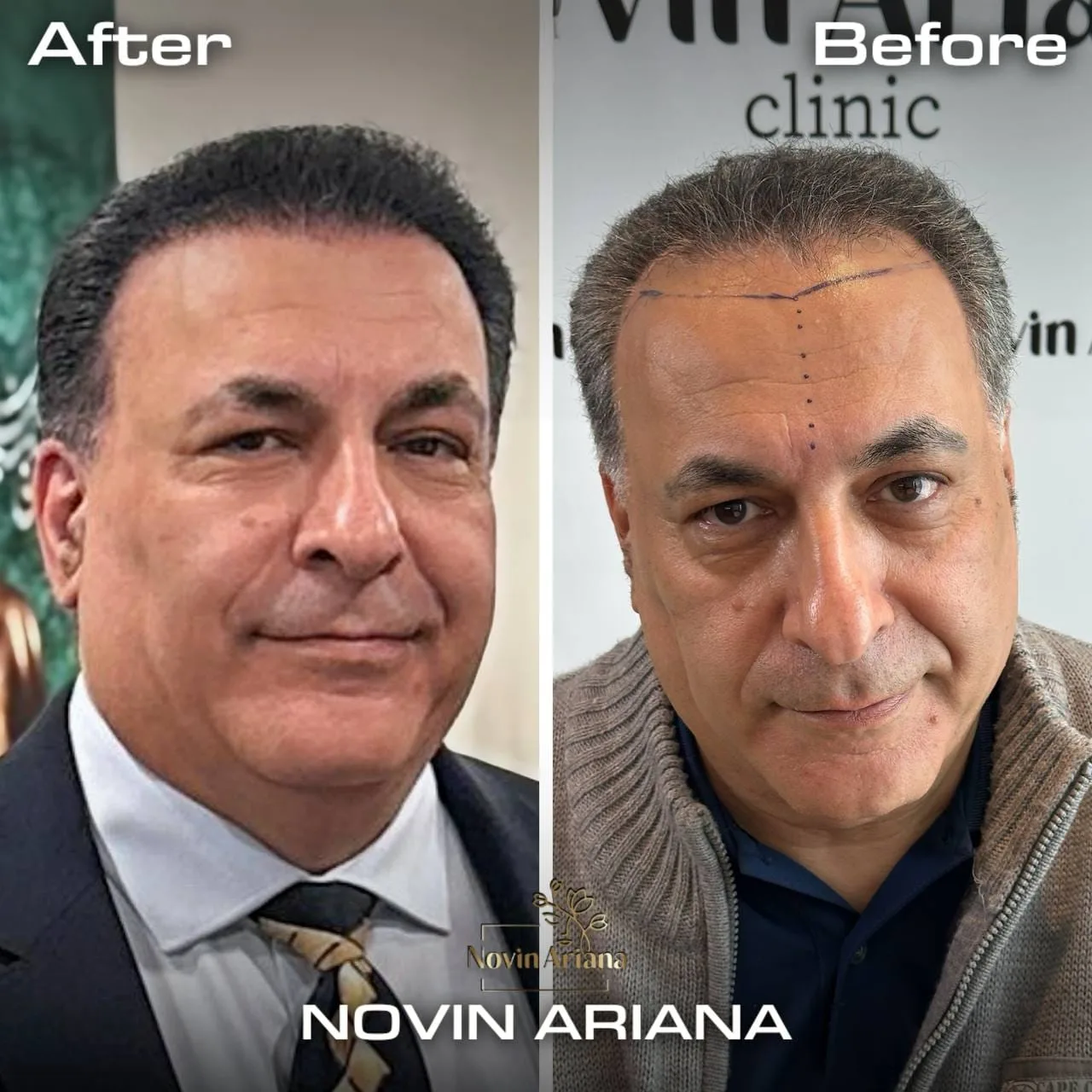 FUE Sapphire — Novin Ariana BHT Hospital