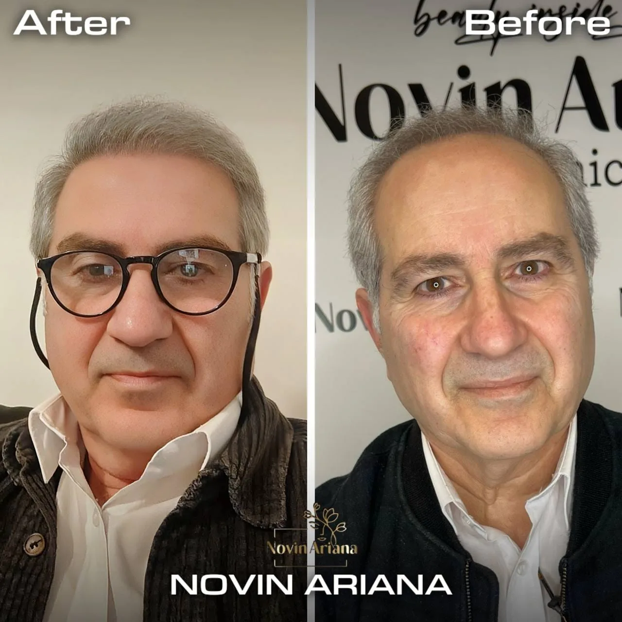FUE Sapphire — Novin Ariana BHT Hospital
