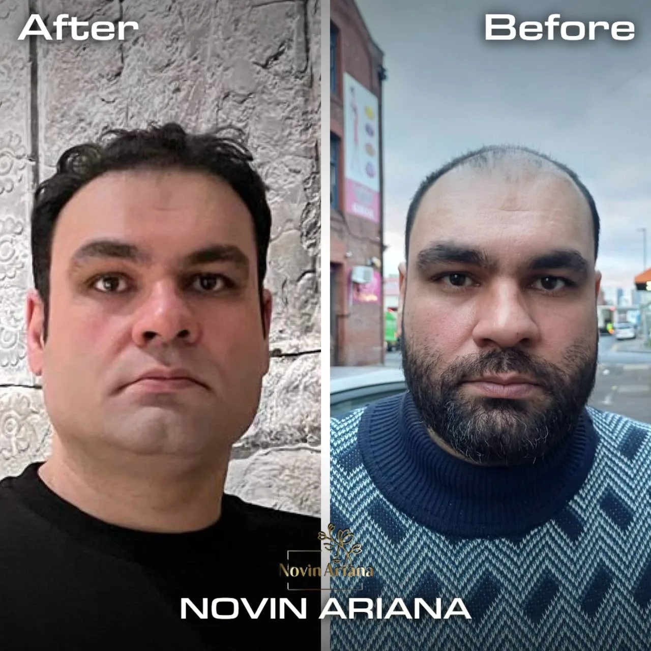 FUE Sapphire — Novin Ariana BHT Hospital