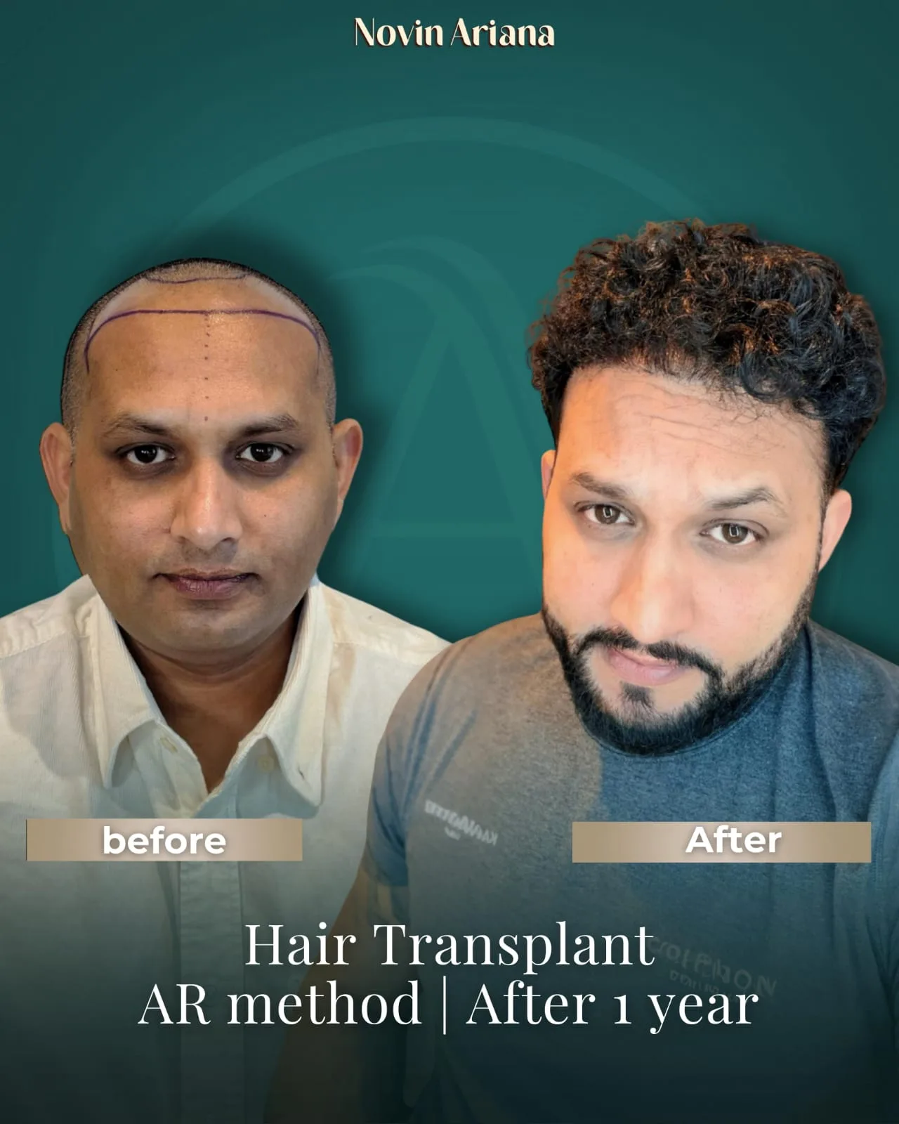 FUE Sapphire — Novin Ariana BHT Hospital