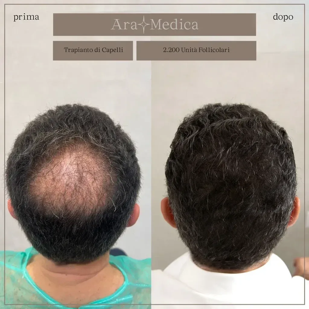 FUE — AraMedica
