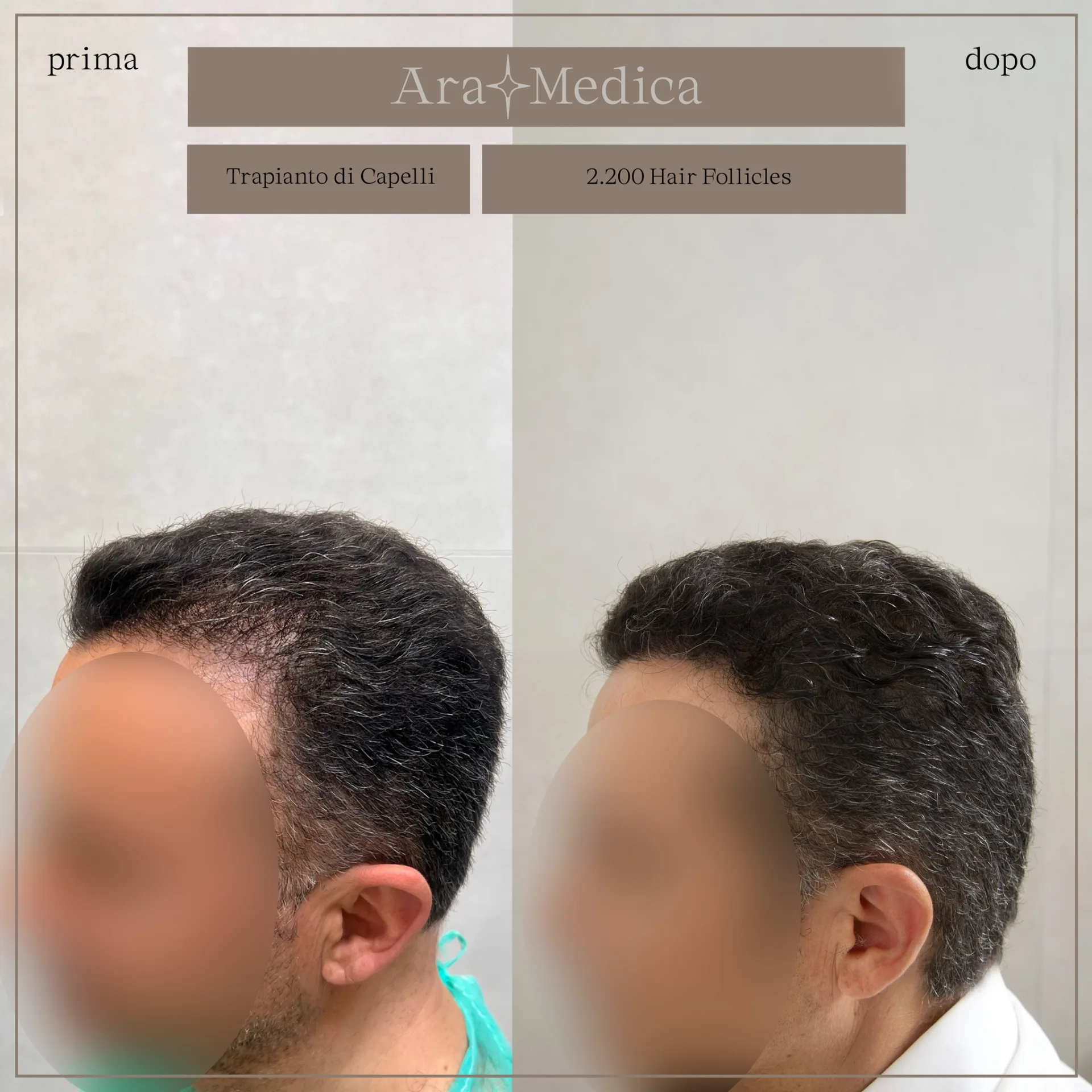 FUE — AraMedica