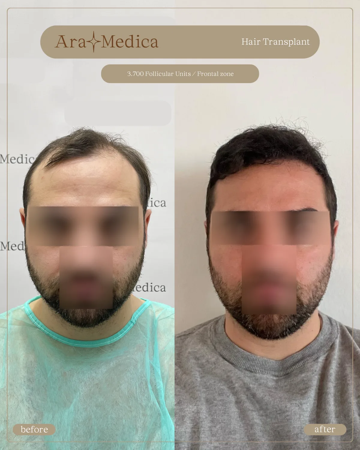 FUE — AraMedica