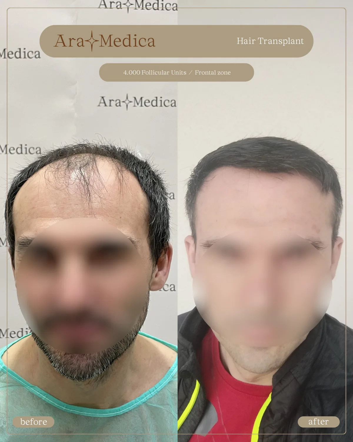 FUE — AraMedica