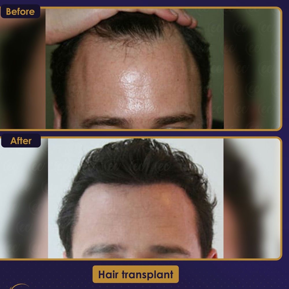 FUE — Estherian clinic