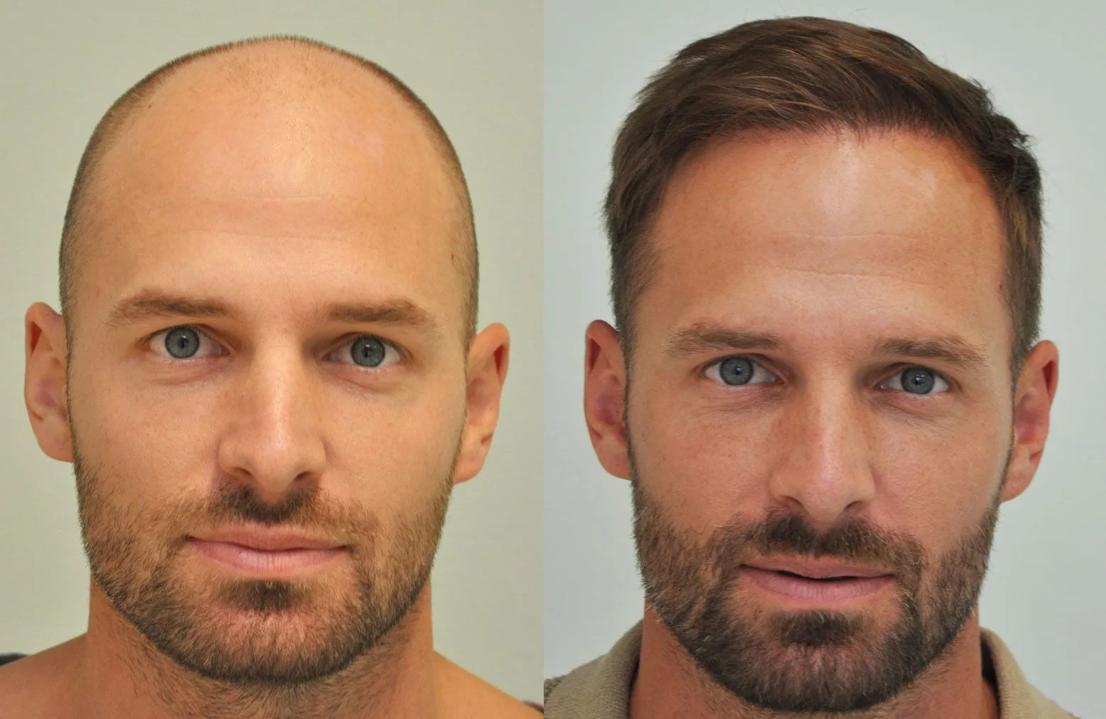 FUE by Doctor — Dr. Sikos Geza Clinic