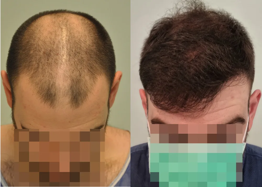 FUE by Doctor — Dr. Sikos Geza Clinic