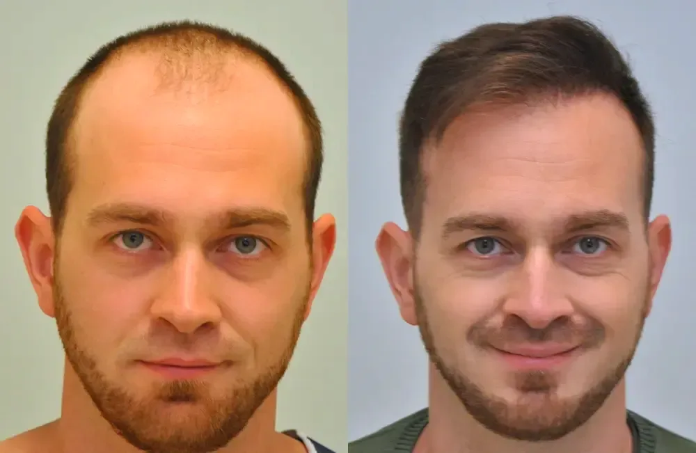 FUE by Doctor — Dr. Sikos Geza Clinic