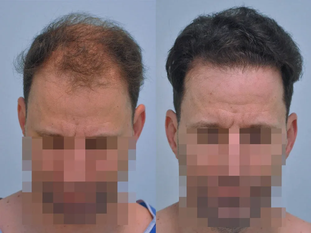 FUE by Doctor — Dr. Sikos Geza Clinic