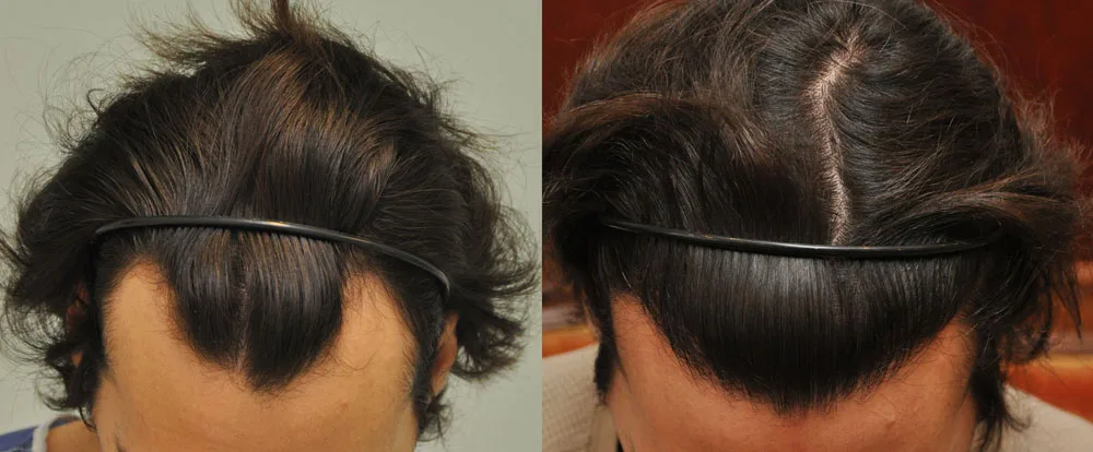 FUE by Doctor — Dr. Sikos Geza Clinic