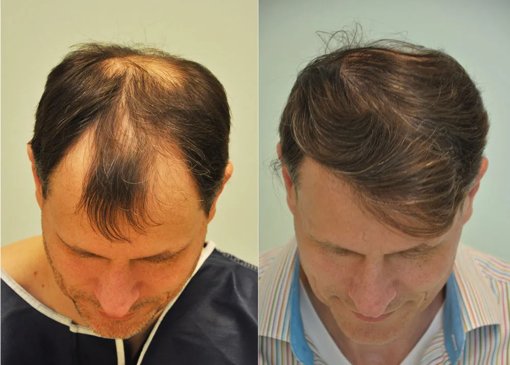 FUE by Doctor — Dr. Sikos Geza Clinic