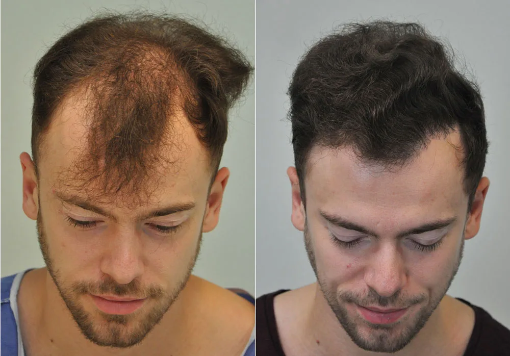 FUE by Doctor — Dr. Sikos Geza Clinic