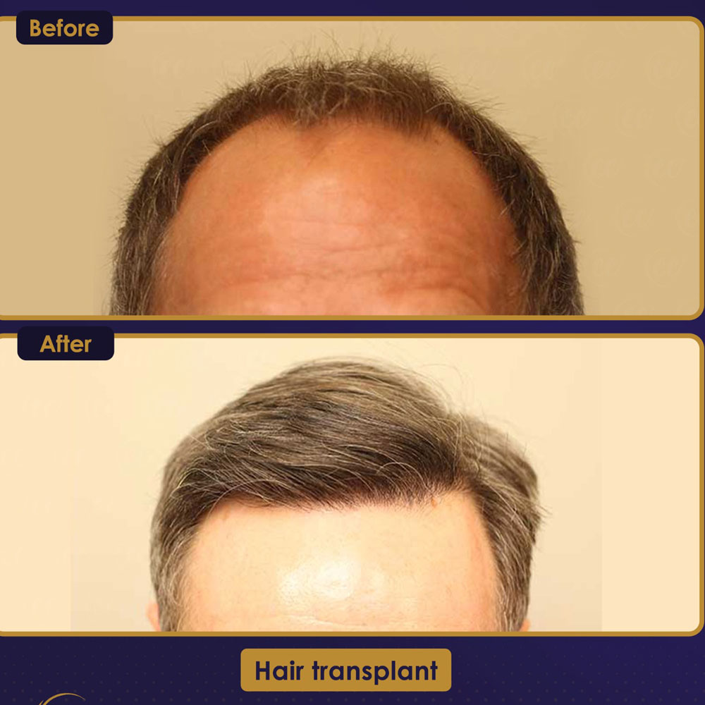 FUE — Estherian clinic