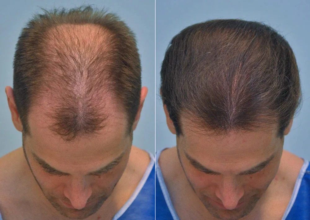 FUE by Doctor — Dr. Sikos Geza Clinic