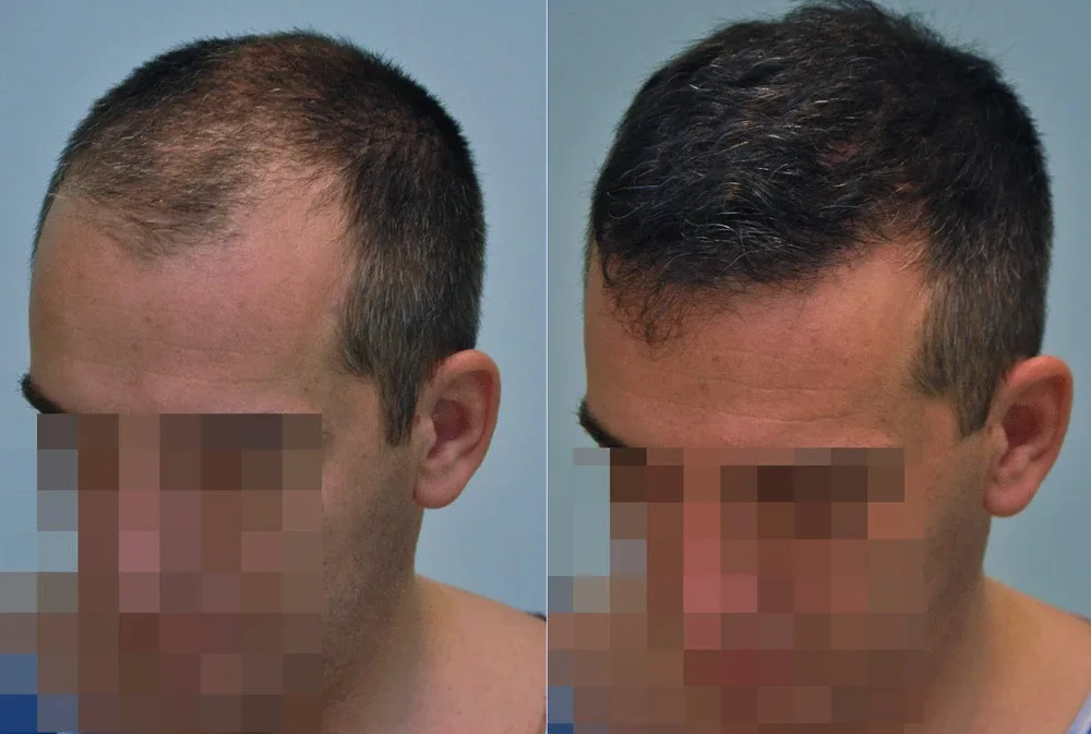 FUE by Doctor — Dr. Sikos Geza Clinic
