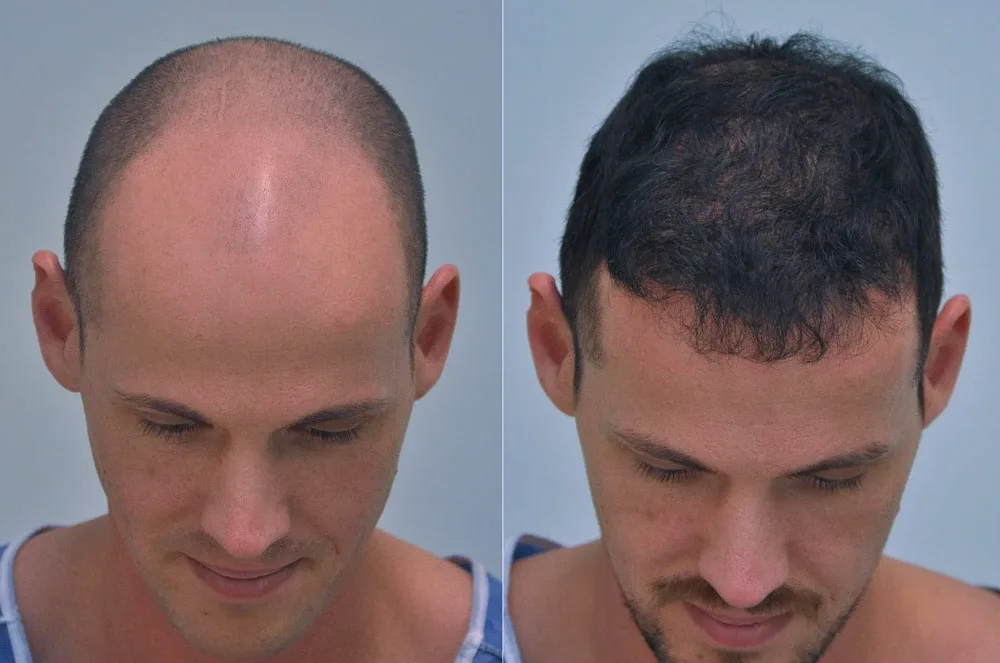 FUE by Doctor — Dr. Sikos Geza Clinic